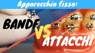 Bande VS attacchi apparecchio fisso [upl. by Philipp]