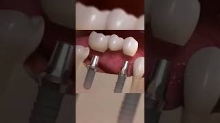 Bridge dentaire sur Implant [upl. by Weylin]