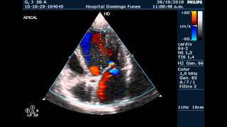 Miocardiopatia dilatada en varon de 50 anos con insuficiencia cardiacawmv [upl. by Ethe483]