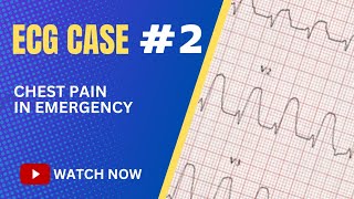 ECG Case 2 Chest Pain in Emergency Department [upl. by Anetsirk]