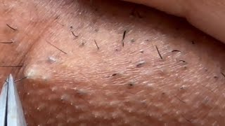 INGROWN HAIR REMOVAL 102  Longest Plucking Video Yet  DermaplaningEyebrow Shaving [upl. by Elok]