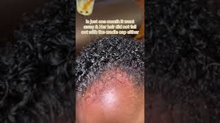 Gentle Cradle Cap Removal Tips to Minimize Hair Fall lachelbeaute shorts [upl. by Patrizio]