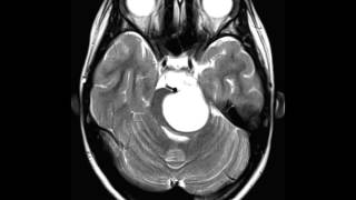 Pilocytc Astrocytoma [upl. by Dur]