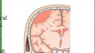 Brain Hematomas  EMS Head Injury Patients [upl. by Anastassia]