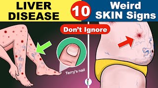 10 Skin signs of Liver Disease  Fatty liver  Cirrhosis of the Liver  Fatty liver Symptoms [upl. by Siloam]