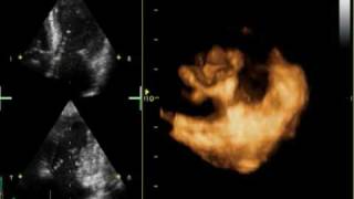 3D MITRAL REGURGITATION PROLAPSE P2 AND P3 [upl. by Alletnahs]