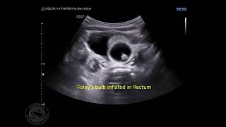 Hydrostatic reduction of Intussusception [upl. by Kathrine]