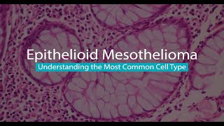 Epithelioid Mesothelioma  Mesothelioma Hope [upl. by Ailecec]