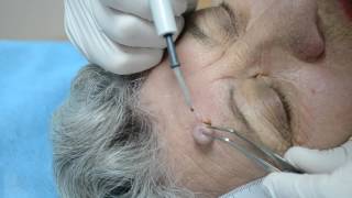 Intra dermal nevus  removal by highfrequency electrosurgery [upl. by Abba982]