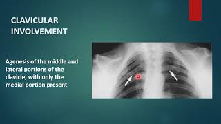 CLEIDOCRANIAL DYSPLASIA  Xray  Radiology [upl. by Asimaj]