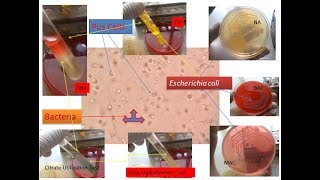 E coli and pus cells in urine [upl. by Phillipe]