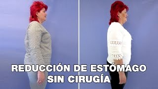 Reducción de Estómago Sin Cirugía  2 Semanas Después del POSE [upl. by Snave]