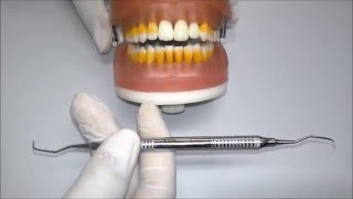 Cureta de Gracey 56  Periodontia 1  UniLeão [upl. by Ainoet]