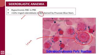 Hematology  1  U8L4  Sideroblastic anaemia [upl. by Genesia87]