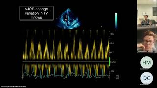 Pericardial Disease [upl. by Elenahc]