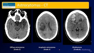 Emergency Imaging of Brain Tumors Astrocytomas [upl. by Mont]