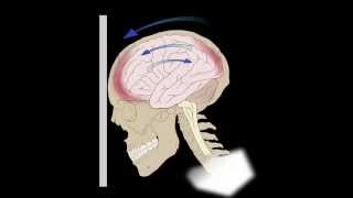 Common Brain Injuries Coupcontracoup [upl. by Inavihs]