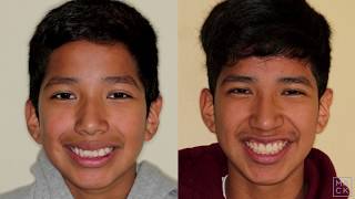 Traditional Braces to Fix Severe Overbite Overjet and Crowding with Extractions [upl. by Ahsiek260]