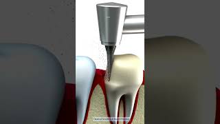 Dental Scaling amp Root Planing  prosper dentalscaling dentist deepcleaning [upl. by Antrim]