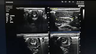 Intussusception Ultrasound [upl. by Jezrdna]