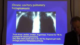 Diagnosis and treatment of chronic pulmonary aspergillosis [upl. by Lled]