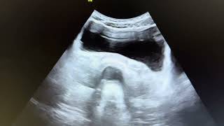 BOO In 25 yr f  Pt was not able to pass urine  Distended rectosigmoid colon compressing bladder [upl. by Ynahirb]