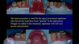 DENT 718 Repairing complete and partial dentures [upl. by Ahseetal]