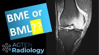 Should we use Bone Marrow Edema or Bone Marrow Lesion [upl. by Beitz]