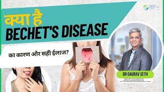 क्या है BECHETS DISEASE का कारण और सही ईलाज  What is Bechets Disease  Dr Gaurav Seth [upl. by Andel]