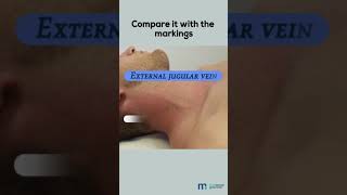 Examination of Jugular Venous Pulse [upl. by Quartis]