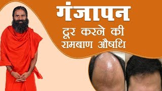 गंजापन  Baldness दूर करने की रामबाण औषधि  Swami Ramdev [upl. by Sherrer]