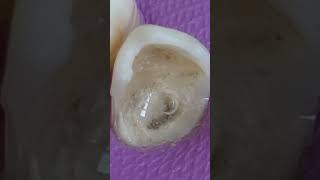 Teeth Cosmetic surgeryHow to restore teeth cavity hol dentistshortsviralshortteeth talk girl [upl. by Idnor]