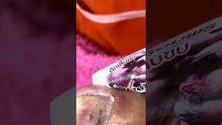 Professional ingrown toenail procedure video 006 [upl. by Birkner]