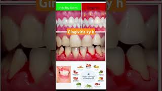 About gingivitis disease medicine medicaldegree drugeducation [upl. by Atiuqrahs990]