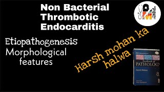 Non Bacterial Thrombotic Endocarditis  NBTE [upl. by Yddub722]