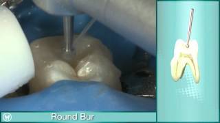 Pulp Chamber Access with Riitano Access Burs Kit [upl. by Halladba518]