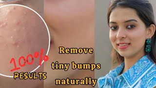 How to remove tiny bumps on face [upl. by Sterling]