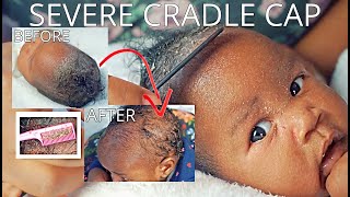 HOW TO GET RID OF ECZEMA  CRADLE CAP ON NEWBORN SCALP FAST  Bubs Bee [upl. by Uhayile]