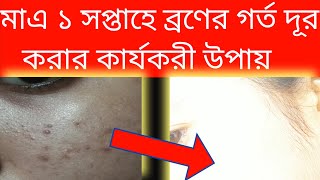 ঘরে থাকা তিনটি উপকরনের মাধ্যমে ব্রণের গর্ত দূর করার উপায়  Ways to remove acne holes [upl. by Romilly402]