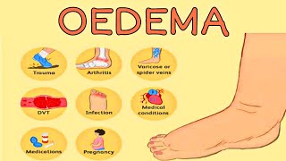 OEDEMA  TYPE OF OEDEMA  OEDEMAS CAUSES [upl. by Leibarg]