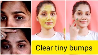 3 दिन में माथे और चहरे से दाने को हटाएं How to remove tiny bumps on forehead and face [upl. by Alyakcim]