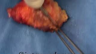 Inside the OR with justageneralsurgeon  cutting open a ginormous Epidermoid cyst [upl. by Fuld]