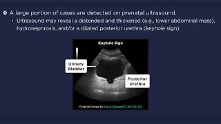 Posterior Urethral Valves [upl. by Noyerb373]