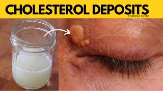 Fastest Way To Get Rid Of Xanthelasma  Squeeze Out Cholesterol Deposits Around Your Eyes [upl. by Alverson]