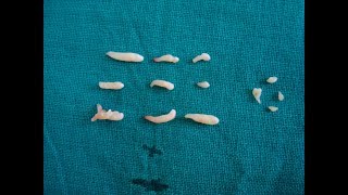 Composite Odontoma surgical removal Additional teeth  dental issues [upl. by Muns]