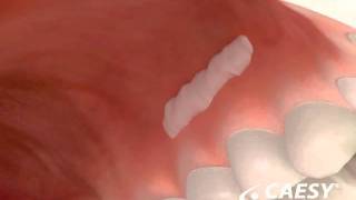 Periodontal Disease Surgery Free Gingival Graft [upl. by Cosette764]