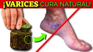 ¡QUITA las VARICES en las PIERNAS RÁPIDAMENTE  MALA CIRCULACIÓN TRATAMIENTO NATURAL [upl. by Maribeth]