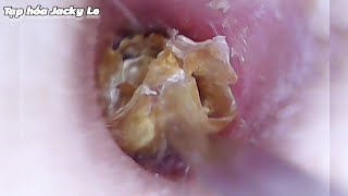 Ear Wax Removal 173 Thick and hard earwax causes ear pain and itching  Ear Cleaning ASMR [upl. by Adnek]