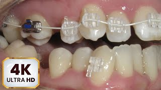 HOW BRACES WORK Sapphire braces Protruding chin in ADULT patient 4k Crossbite timelapse [upl. by Ayifas661]