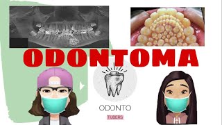 ODONTOMA TUMOR ODONTÓGENO [upl. by Erodoeht708]